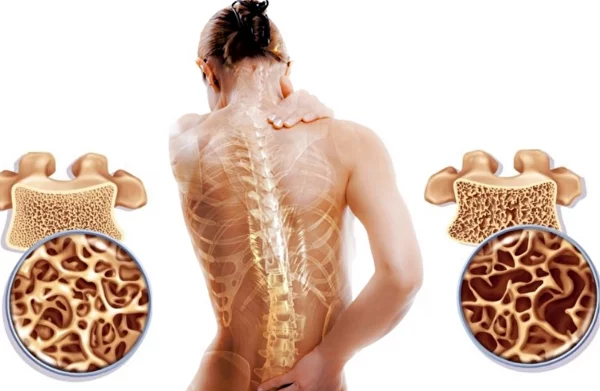 Что такое остеопороз
